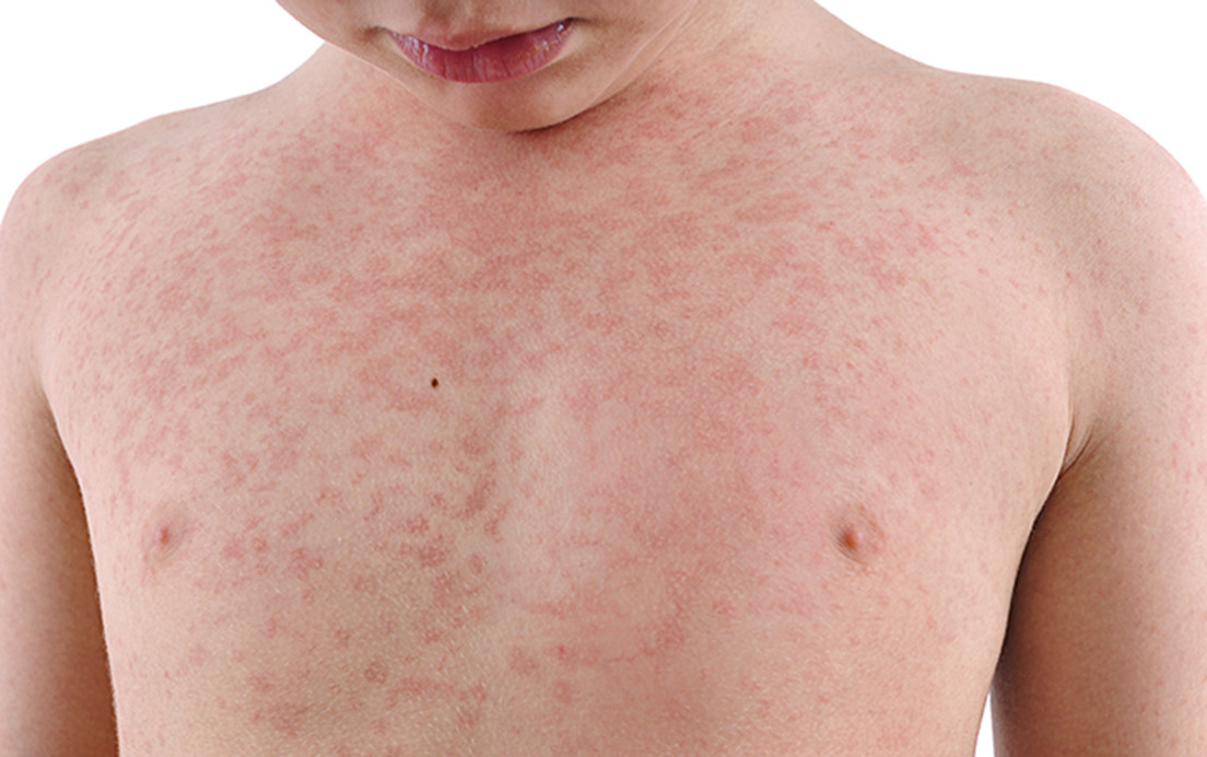 Measles